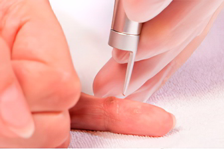 Удаление гигромы лазером Удаление гигромы лазером