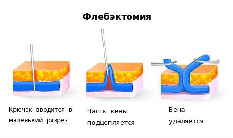 Флебэктомия Флебэктомия