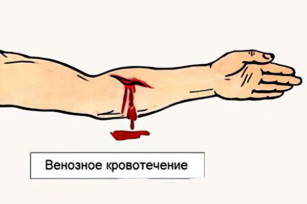 Признаки венозного кровотечения Признаки венозного кровотечения
