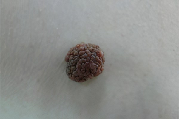 Веррукозный невус Веррукозный невус