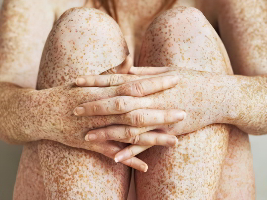 Веснушки Веснушки