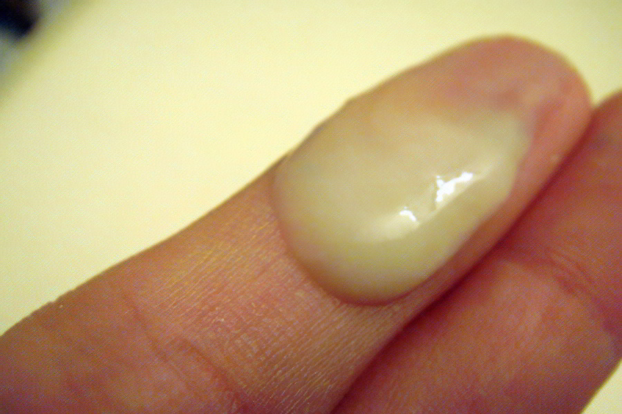 Симптомы гонореи у женщин Симптомы гонореи у женщин