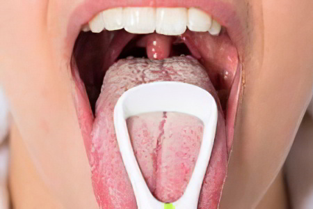 Виды кандидозного Виды кандидозного