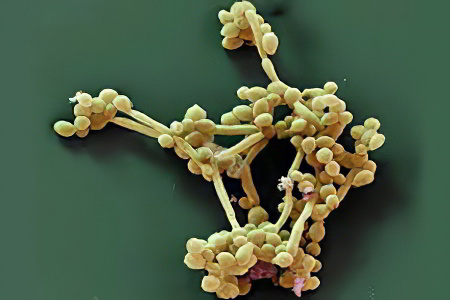 Виды и стадии отомикоза Виды и стадии отомикоза