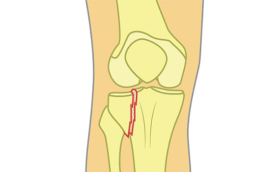 Внутрисуставной перелом Внутрисуставной перелом
