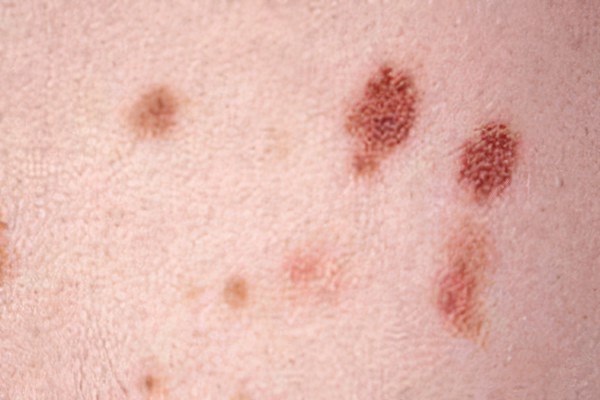 Внутридермальный невус Внутридермальный невус