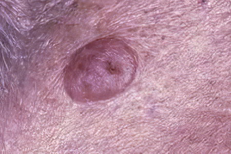 Внутриэпидермальный невус Внутриэпидермальный невус