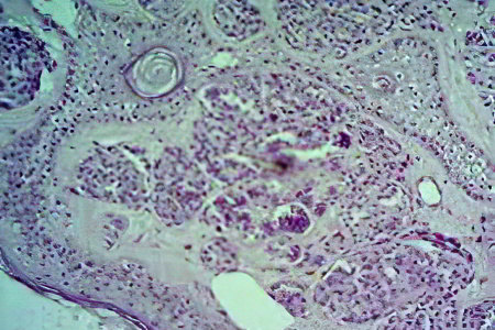 Внутридермальный невус Внутридермальный невус