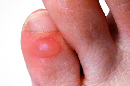 Водяные мозоли на ногах Водяные мозоли на ногах