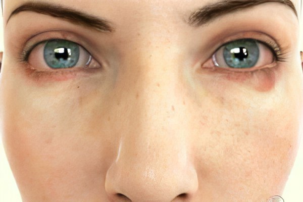 Воспаление верхнего и нижнего века Воспаление верхнего и нижнего века