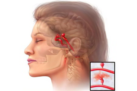 аневризма врождённого характера аневризма врождённого характера
