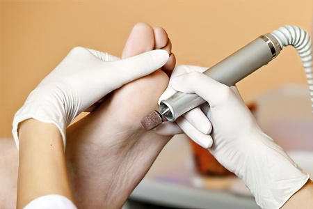 Удаление натоптышей Удаление натоптышей