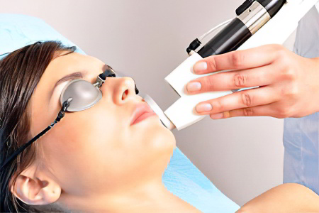 Выведение при помощи лазера Выведение при помощи лазера