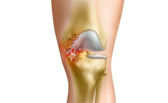 Ушиб в области коленного сустава Ушиб в области коленного сустава