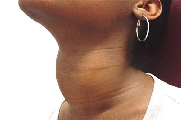 увеличение щитовидной железы увеличение щитовидной железы