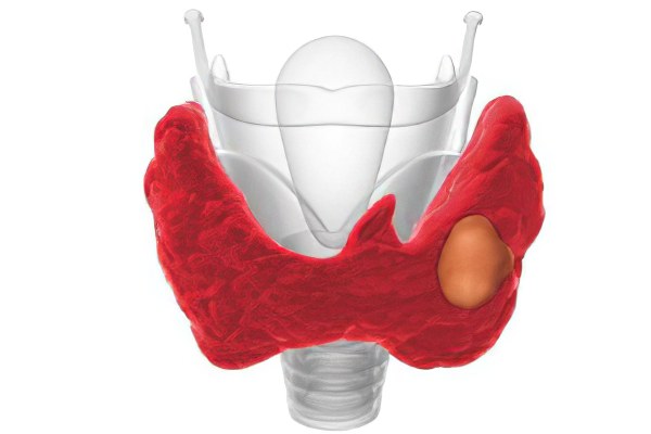 Диффузно-узловой зоб Диффузно-узловой зоб