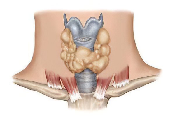 Диффузно-узловой зоб Диффузно-узловой зоб