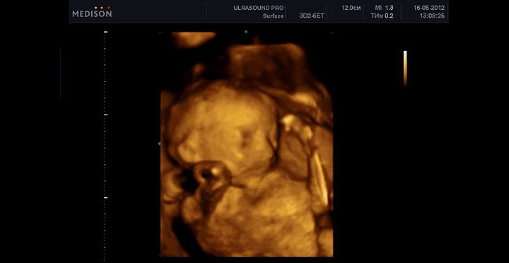 УЗИ плода на 25 неделе беременности УЗИ плода на 25 неделе беременности