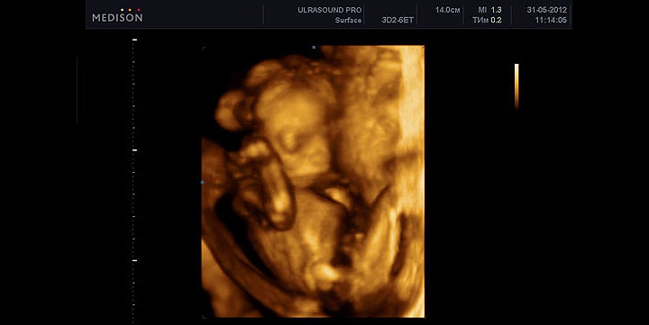 3d УЗИ на 18 неделе беременности 3d УЗИ на 18 неделе беременности
