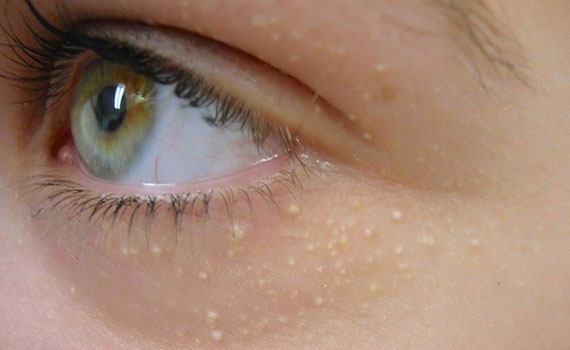 Белые угри Белые угри