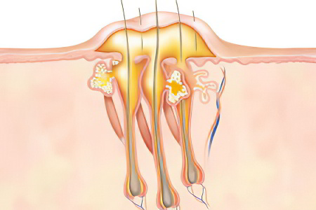 карбункул карбункул
