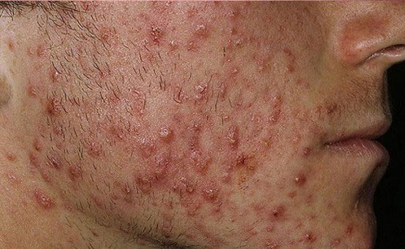 Конглобатные угри Конглобатные угри