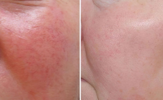 Розовые угри Розовые угри