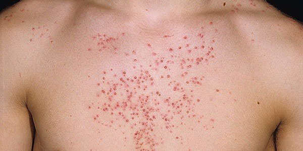 Стероидные угри Стероидные угри