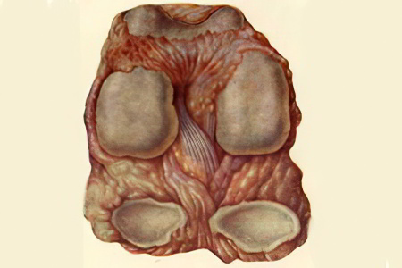 Боль в тазобедренном суставе Боль в тазобедренном суставе