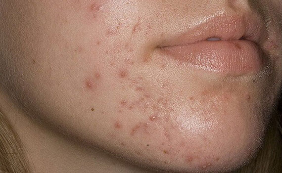 Вульгарные угри Вульгарные угри