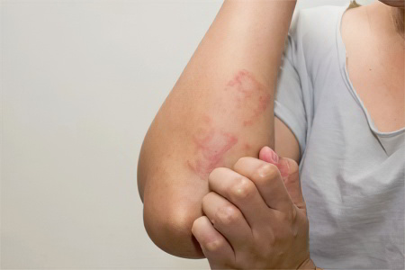 Аллергические реакции Аллергические реакции