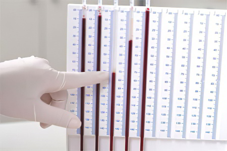 Норма оседания эритроцитов Норма оседания эритроцитов