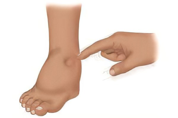 анасарка анасарка