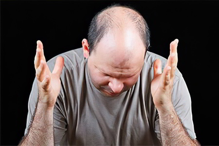 Андрогенная алопеция Андрогенная алопеция