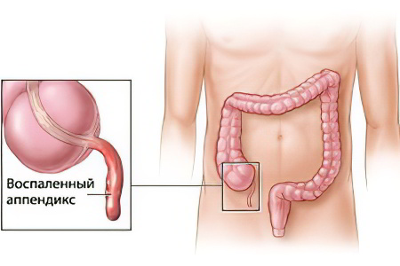 аппендицит аппендицит