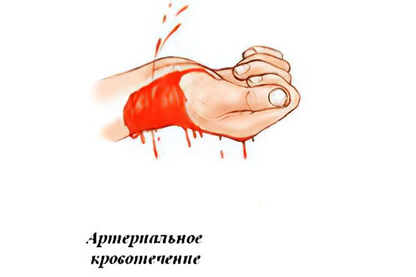 Первая помощь при артериальном кровотечении Первая помощь при артериальном кровотечении