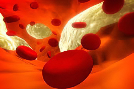 нестенозирующий атеросклероз артерий нестенозирующий атеросклероз артерий