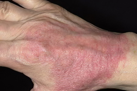 Атопический дерматит Атопический дерматит