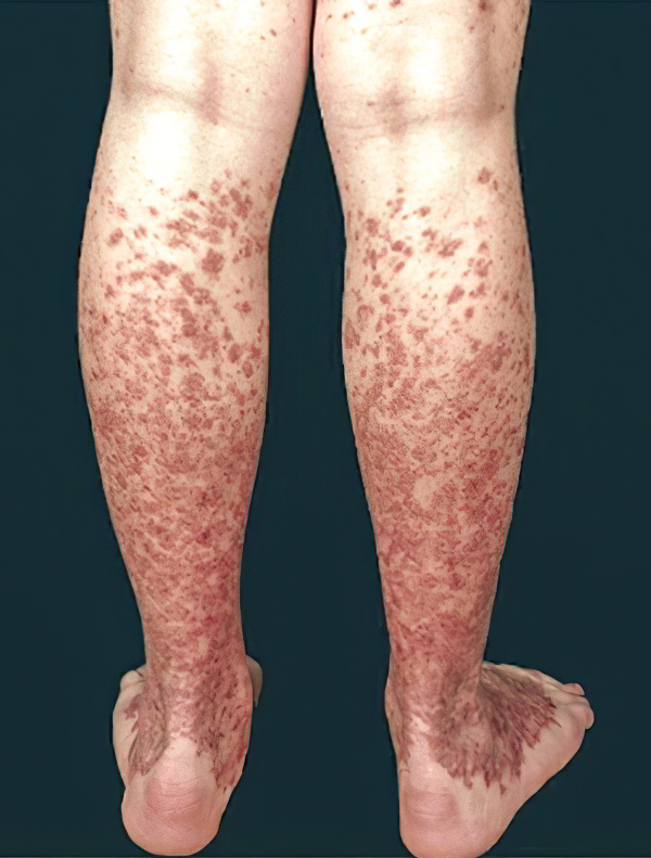 Гемосидероз кожи Гемосидероз кожи