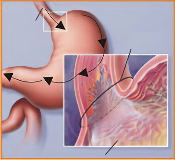 бродильная диспепсия бродильная диспепсия