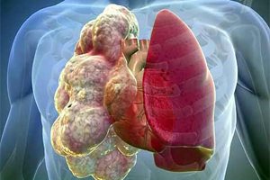 Буллезная (пузырчатая) форма Буллезная (пузырчатая) форма