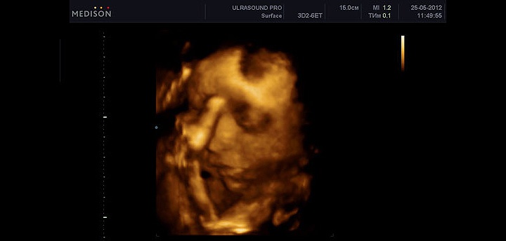 УЗИ на 39 неделе беременности УЗИ на 39 неделе беременности