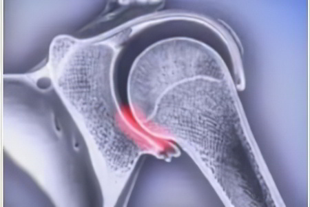 Что такое вывих Что такое вывих