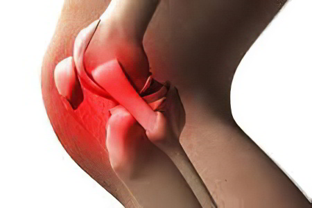 Что может хрустеть в колене Что может хрустеть в колене
