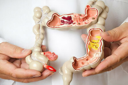 Что представляет собой энтероколит Что представляет собой энтероколит