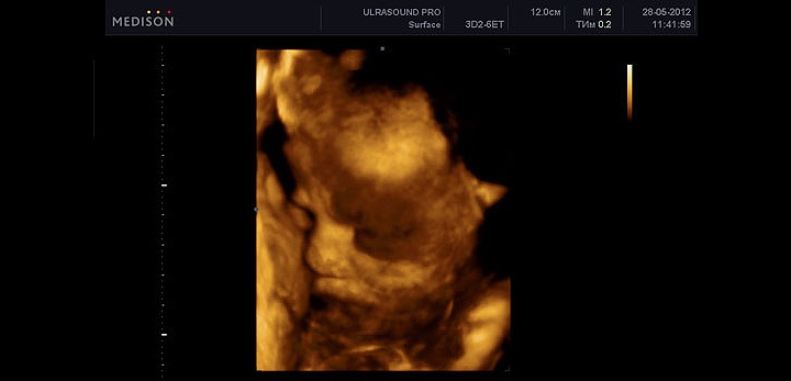 УЗИ на 35 неделе беременности УЗИ на 35 неделе беременности