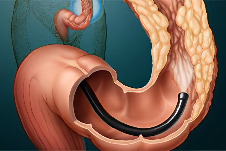 Диагностика рака прямой кишки Диагностика рака прямой кишки
