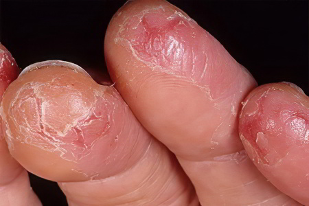 Причины дисгидротической экземы Причины дисгидротической экземы