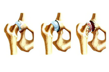 дисплазия тазобедренного сустава дисплазия тазобедренного сустава