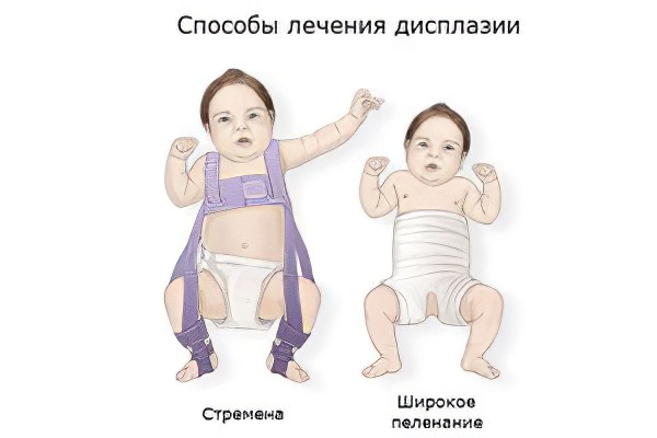 Лечение дисплазии тазобедренных суставов Лечение дисплазии тазобедренных суставов